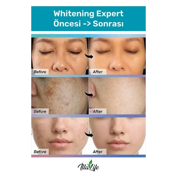 Illa Life Whitening Expert Hızlı Etkili Diş Jel Yeni Nesil Diş Beyazlatma Ve Temizleme Jeli 50 Ml - Görsel 4
