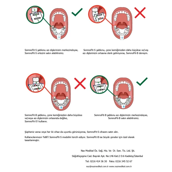 Somnofit-S, Mandibular (Alt Çene) Ilerletme Aparatı - Görsel 6