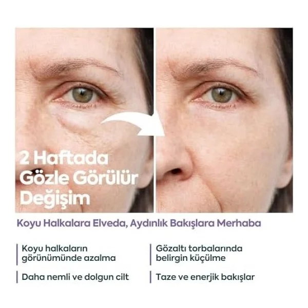 Clasycare Göz Altı Kremi - Kafein%5 + Hyaluronik Asit%2 - Morluk, Torba ve Şişlik Karşıtı Göz Kremi - Kırışıklık, Ince Çizgi ve Göz Altı Aydınlatıcı Krem, 40 ml - standart - Görsel 3