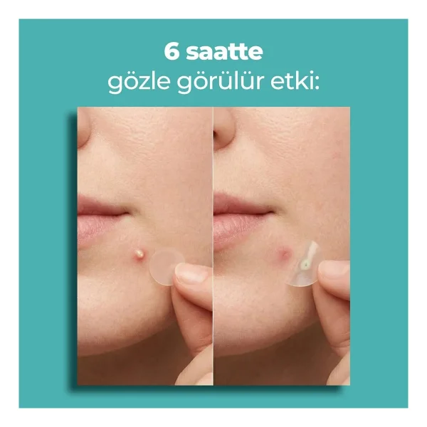 kleccs Sivilce Bandı, Orijinal-Profesyonel Bakım, 144 Adet, Hidrokolloid Akne Bandı - Görsel 2