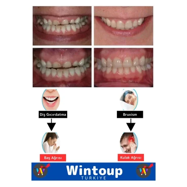 Özel Tasarım Çene Sıkma Diş Gıcırdatma Bruxism Gece Plağı Koruyucu Aparat Dişlik Uyku Aparatı 1 Adet - Görsel 2