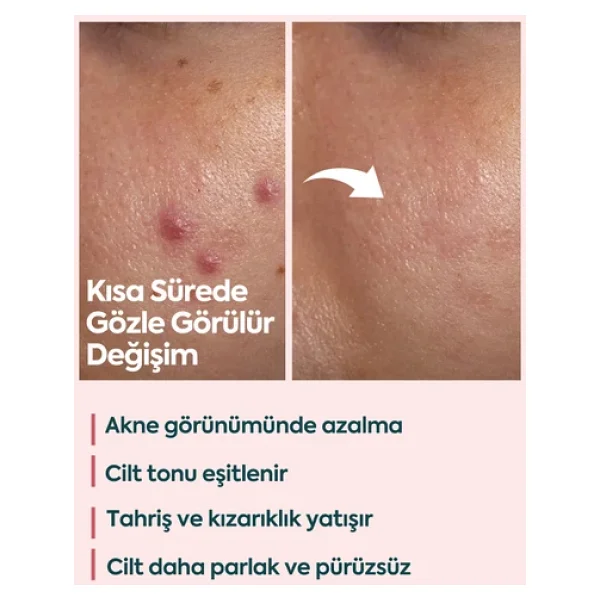 Clasy Care Face Up Skin Sivilce Kremi 40 Ml - Görsel 5