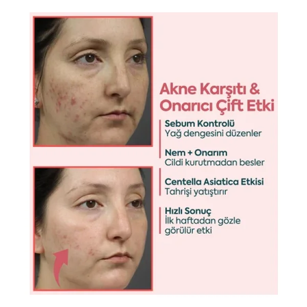 Clasy Care Face Up Skin Sivilce Kremi 40 Ml - Görsel 4