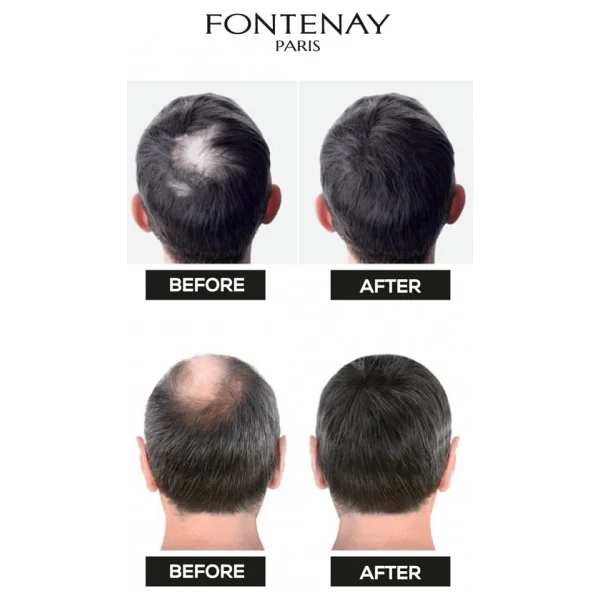 Fontenay Saç Dolgunlaştırıcı Keratin Fibers Siyah Topik Saç Tozu 50gr + Saç Spreyi 400ml 2'li Set 2 - Görsel 7