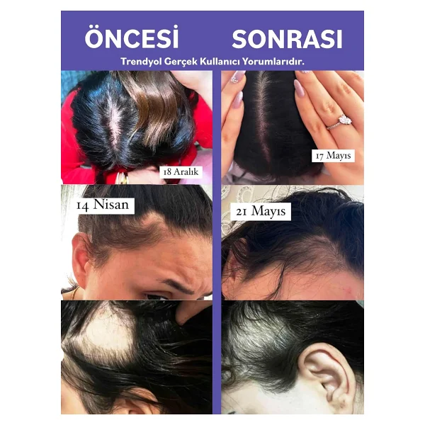 Radix Anti Hair Loss 60 Ml Dökülme Karşıtı Saç Losyonu - Görsel 9