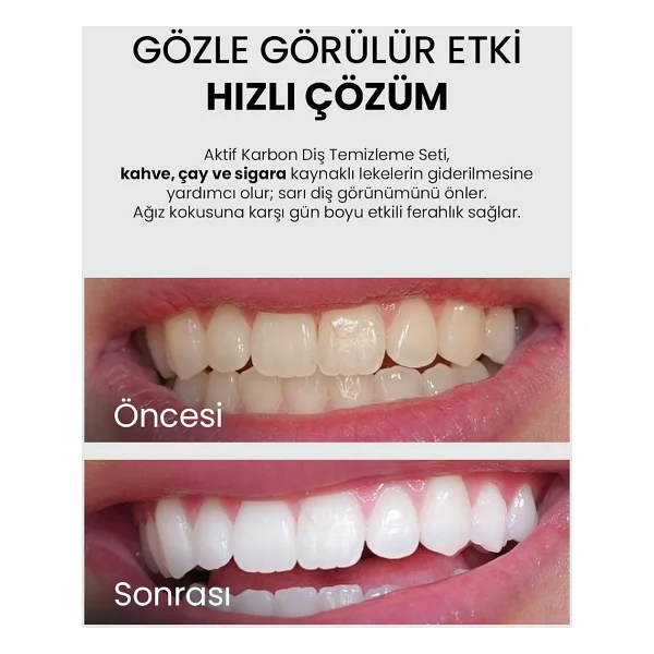 Luis Bien Diş Beyazlatma Seti - Görsel 5