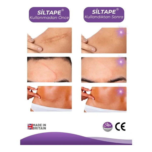 Advancis Medical Uk Siltape Soft Silikon Yara İzi Dikiş İzi Sezaryen Yanık Estetik Bant 2 Cm X 3 M - Görsel 2