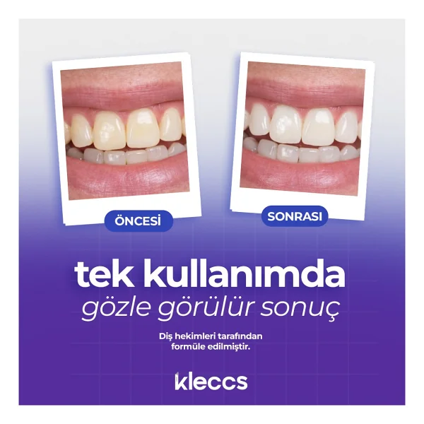 Kleccs Diş Beyazlatma Bandı, Hızlı Beyazlık, 14 Paket-28 Bant, Günlük Ve Bireysel Kullanıma Uygun - Görsel 2