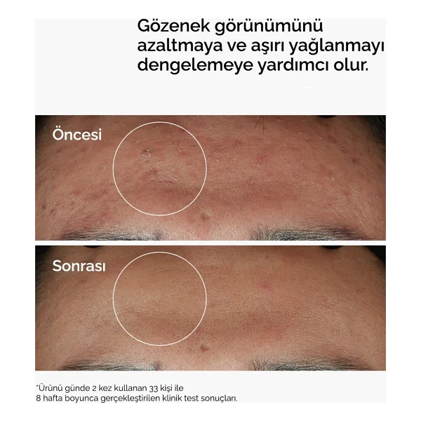 The Ordinary Leke Ve Gözenek Karşıtı Zinc 1% + 10% 60 Ml Niasinamid Serum - Görsel 3
