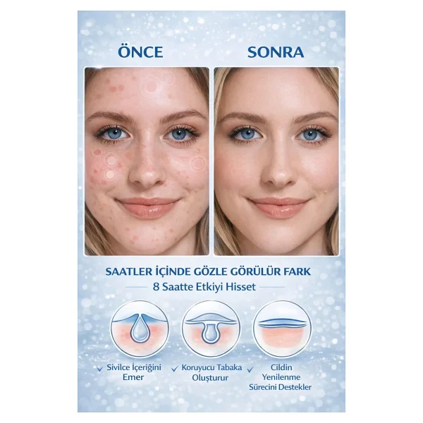 Jejudo Pimple Patch,Akne Bandı(9mm&12mm)+4,5 Ml Likit Pimple Pen,%100 Hidrokolloid,%2 Salisilik Asit - Görsel 9