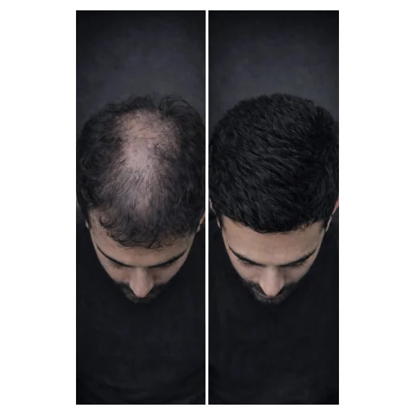 Quad Siyah Saç & Sakal Toz Kapatıcı Dolgunlaştırıcı Pudra - Doğal Topik Etki 10gr - Görsel 10